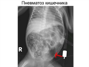 Что означает пневматоз почки