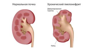 Хронический вторичный пиелонефрит осложнения