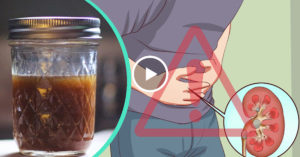Моча мутная при камнях в почках
