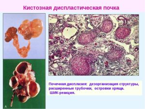 Дисплазия почек классификация