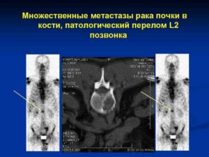 Метастазы почек рак