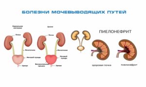 Пиелонефрит цистит чем лечить