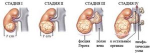 Рак почки симптомы признаки у детей