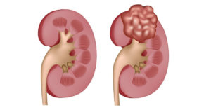 Киста на почке или рак