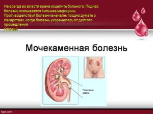Презентация на тему мочекаменная болезнь
