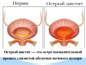 Цистит это инфекционное заболевание или нет