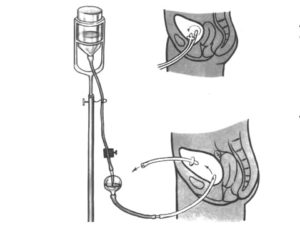 Промывание катетера мочевого пузыря