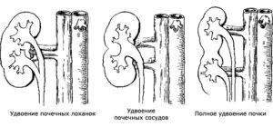 Полное удвоение члс левой почки