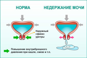 После инсульта недержание мочи можно ли вылечить