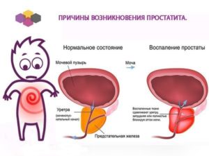 Простатит или цистит