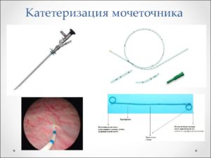 Как вставляется в почку катетер