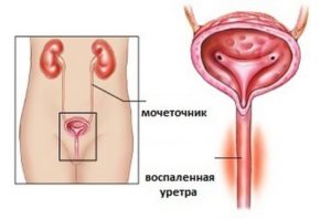 Уретрит у девочки симптомы лечение причины