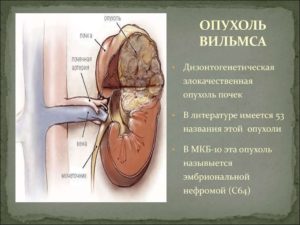 Опухоль вильмса почек