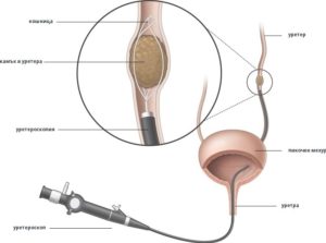 Операция по удалению камня из мочеточника у мужчин