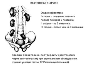 Опущение почки 1 2 степени