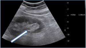 Каликоэктазия обеих почек при беременности