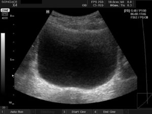 Узи мочевого пузыря и простаты с определением остаточной мочи