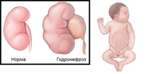 Расширение лоханки почки у новорожденного операция