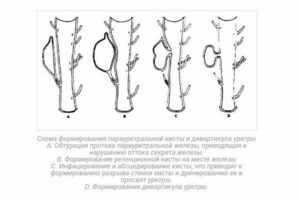Парауретральная киста лечение народными средствами
