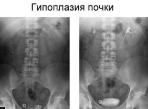 Дают ли инвалидность при гипоплазии почки