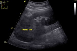 Образования почек узи