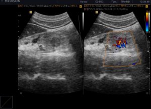 На узи не обнаружили почку