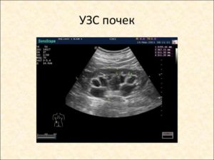 Узи почек при диабетической нефропатии