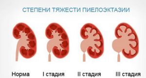 Двухсторонняя пиелоэктазия почек у новорожденного