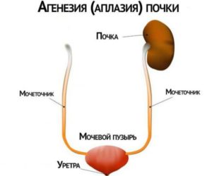 Аплазия почки мкб 10