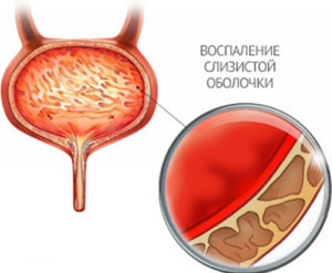 Цистит часто повторяется