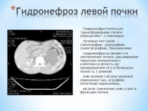 Что такое гидронефротическая трансформация левой почки