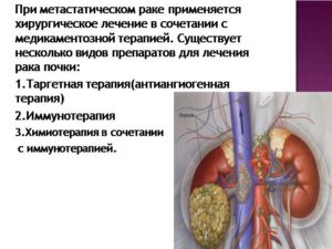 Как лечат рак почки