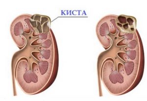 Что такое кальцинированная киста почки