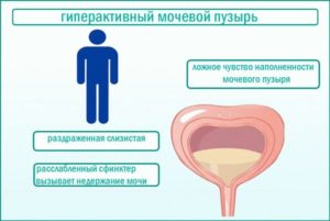 Ощущение наполненности мочевого пузыря у женщин