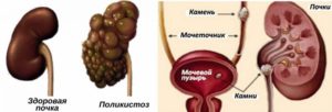 От чего отказали почки