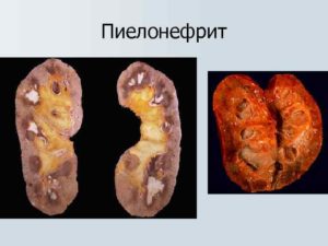 Хронический пиелонефрит и занятия спортом