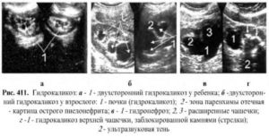 Чем отличается гидрокаликоз от гидронефроза