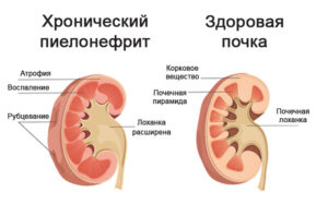 Чем опасен хронический пиелонефрит почек