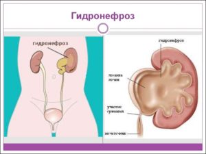 Гидронефроз левой почки у новорожденного лечение