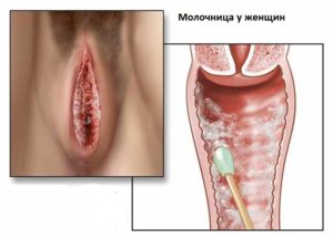 Жжение головки у мужчин без выделений и без запаха