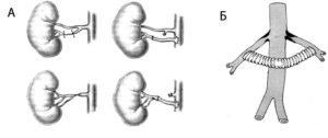 Шунтирование почки что это такое