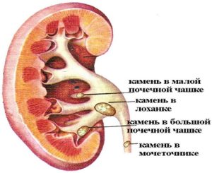 Конкременты чашечек левой почки