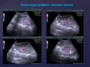 Доплерографическое исследование сосудов почек