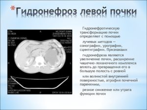 Гидронефроз единственной почки у ребенка