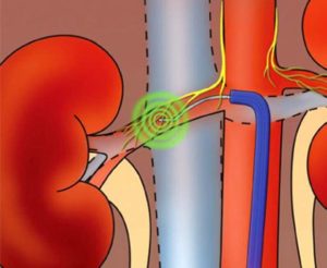 Операция почечной артерии