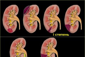 Симптомы при отбитых почках у ребенка