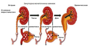 Обструкция в почке