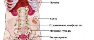 Метастазы в мочевом пузыре прогноз