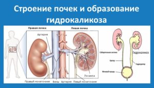 Чем отличается гидрокаликоз от гидронефроза