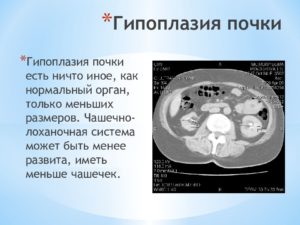 Дают ли инвалидность при гипоплазии почки